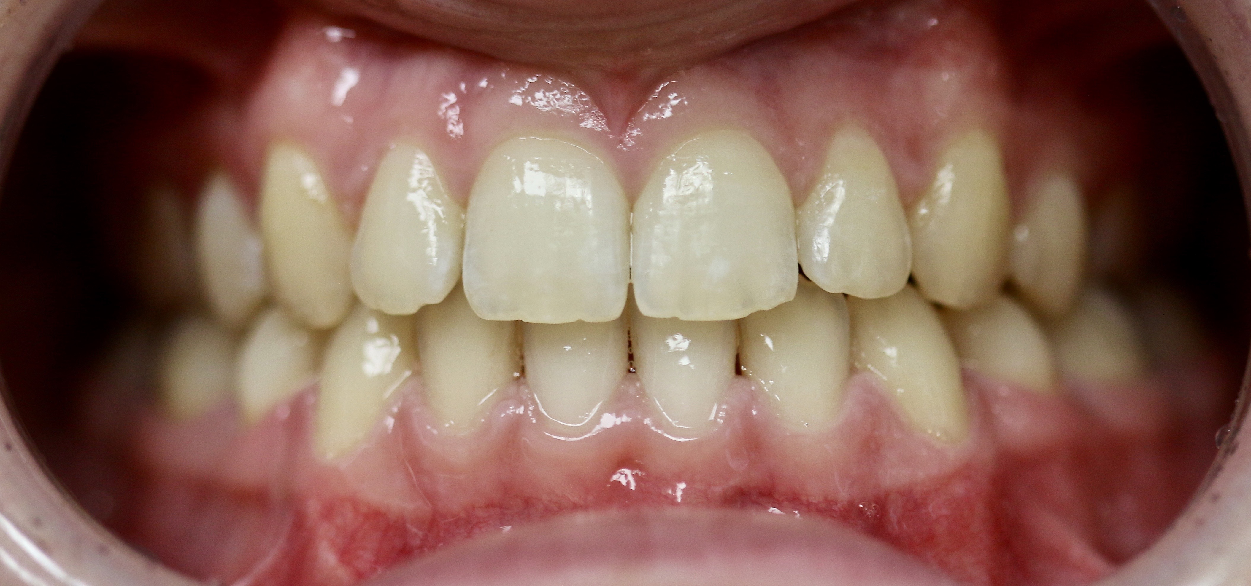 Orthodontics And Braces In Nelson Before And After Photos